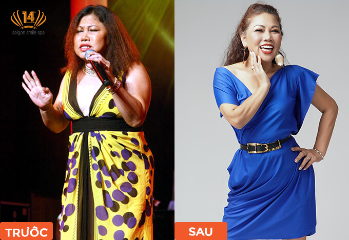 Saigon Smile Spa tiết lộ lí do nữ ca sỹ Siu Black chọn giảm béo một lần us  _anh__truoc_sau_giam_beo