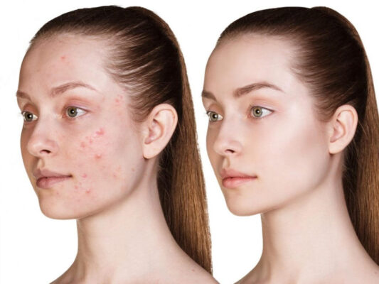 bảng sạn đơn phiếu đánh hot ở tính kế toán hạch vichy menard belas linh