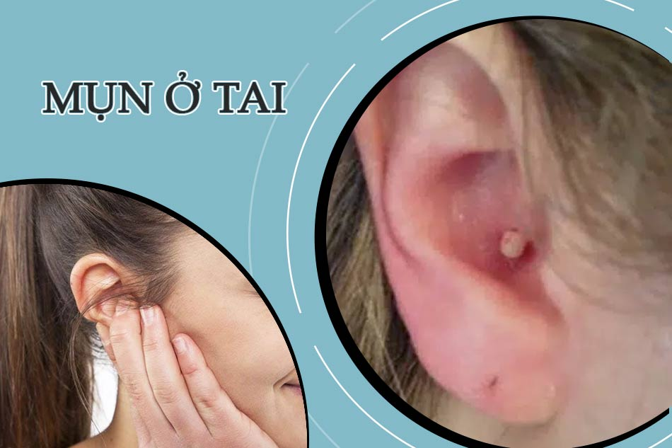 Mọc mụn ở tai đau nhức: Nguyên nhân và cách xử lý