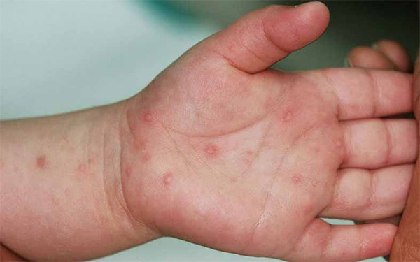 Trẻ bị mụn nước ở tay