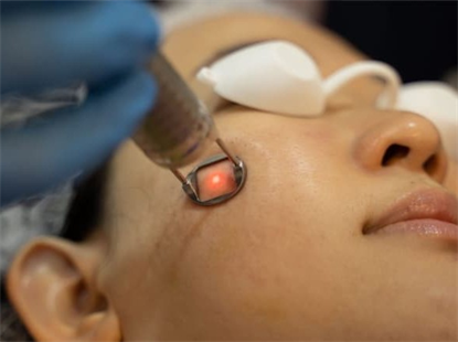 Bắn laser trị tàn nhang - xu thế làm đẹp mới có thực sự hiệu quả?